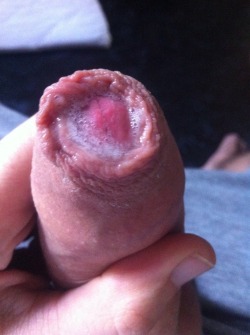 UNCUT/FORESKIN