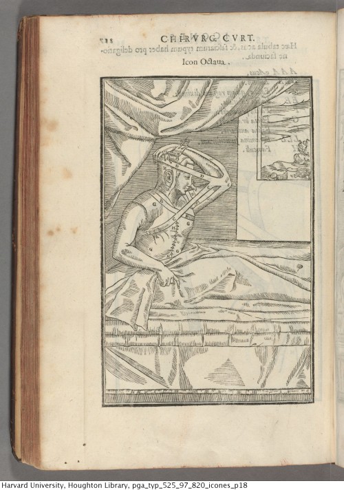 houghtonlib:Tagliacozzi, Gaspare, 1545-1599. De curtorum chirurgia per insitionem, 1599.Typ 525.97.8