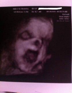 purestofsins:  sixpenceee:  rinasenshii:  sixpenceee a girl I went to highschool with posted a set of photos from her baby’s 3D ultrasounds today. She claims his nose is squished against her placenta so it looks like he doesn’t have one. I say she’s