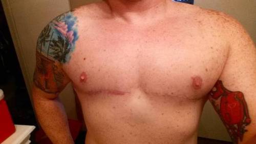 Chest update! Just over 10 months post-op ♡ #topsurgery #garramone #drgarramone #ftm #doubleincision