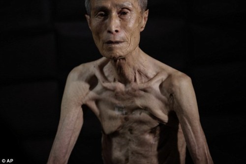 sixpenceee:  Atomic Bomb Survivor: Sumitery Taniguchi The frail 86-year-old body of Sumitery Taniguchi is a web of scars, that have criss-crossed his skin for 70 years. The elderly man was one of the many tens of thousands of victims of the atomic blast