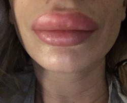 lissybaybe:  My new cocksucking lips… 