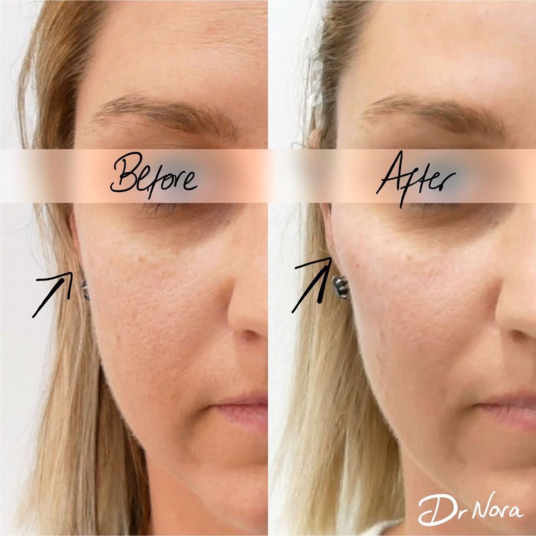 Cheek Fillers 😲Dermal filler placed strategically along the cheeks can help to give definition and contouring to the face. It also creates an up lifting effect to the lower facial features and can help reduce the appearance of nasolabial folds (lines...