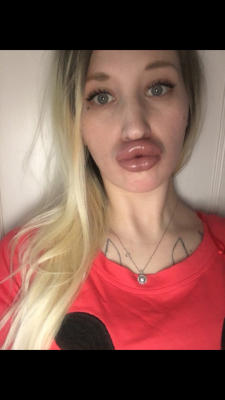 bimbogoddesslover: A dumb blank bimbo doll with her new pumped lips