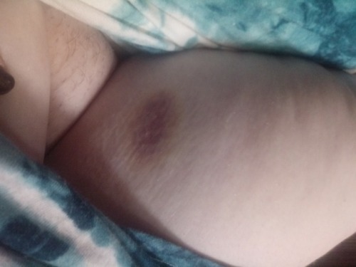 Somehow have this bruise on my inner thigh. And missing underwear with a pussy in need of a shave.