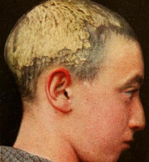biomedicalephemera: Favus of the Scalp and Body Favus (or favid), from the Latin favus, means &ldquo