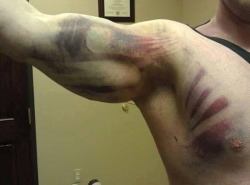 thescienceofjohnlock:  bubblyambii:  My cousin got hit by a truck. He’s fine nothing broken but he has the sickest bruise ever!! Like holy shit you can see the outline of his muscles and bones on his chest? This thing is awesome.  I told him he should