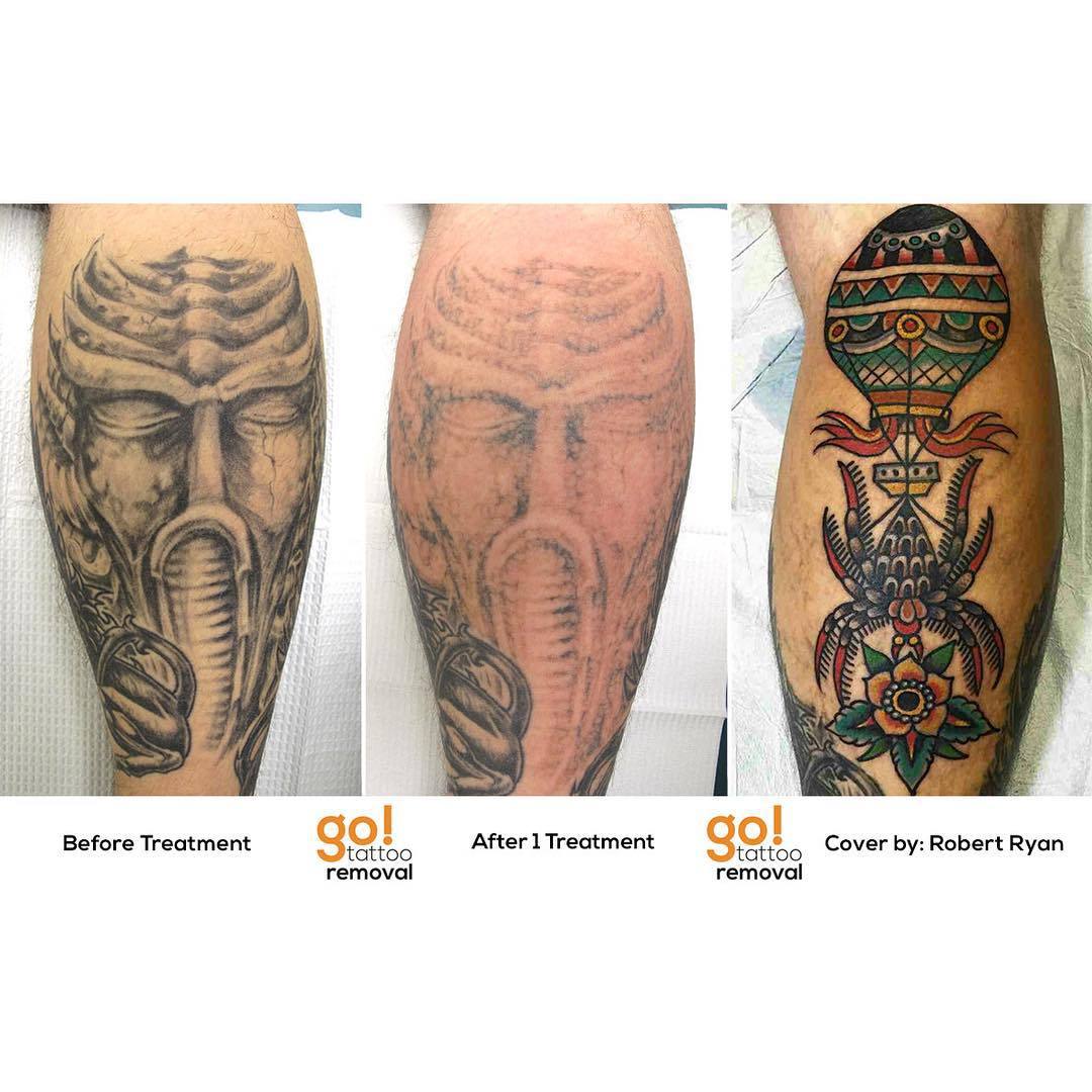 Tattoo Removal in North Sydney  Neutral Bay near Mosman Manly Dee Why  Macquarie Park Brookvale