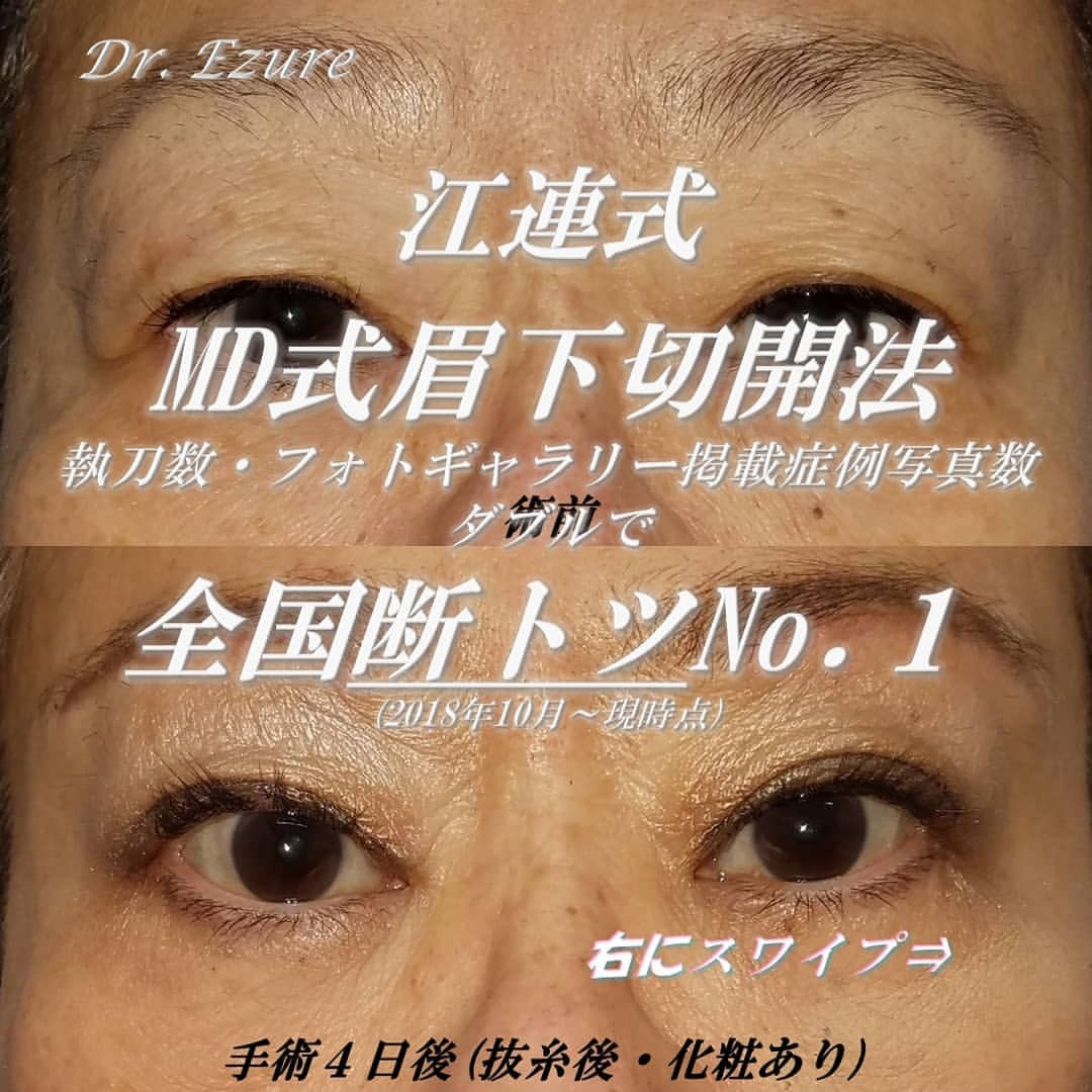 SBC Medical GroupYoshiki Ezure — 全てMD式眉下切開の症例 MD式で半永久的二重調整、たるみ取り😍&hellip;
