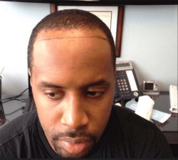 puffsaddy:  kingjaffejoffer:  tarynel: puffsaddy:   gosuckyamudda:   puffsaddy: mood. As many fake asses and breasts and lips and wigs etc that’s out here, you can’t hate on hairline restoration. At all.   self care and he didn’t even spend his