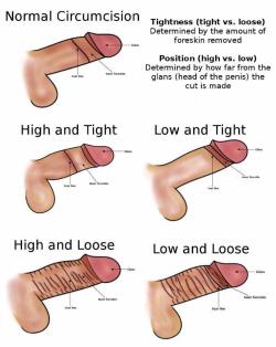 statuscut:  Which style of CIRCUMCISION do