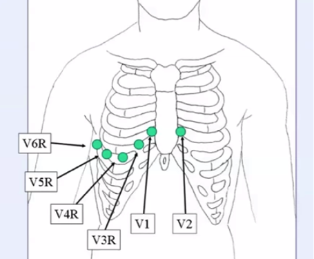 17+ Right Sided Ecg V4R Background