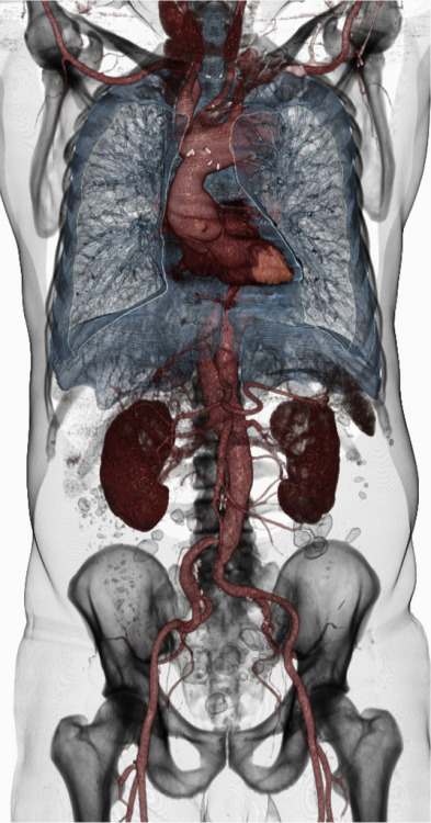 staceythinx:  Volume Rendering CT Scans by voxel123 