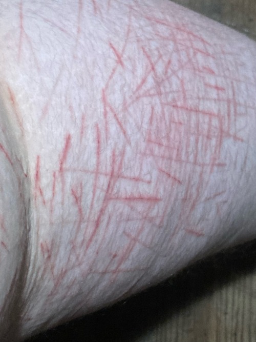 Tw Self H@rm Sc@rs