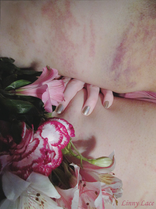 linnylace:Late Valentine’s Day post: this is easily becoming one of my favorite bruise-related photosets. The flowers were picked out specifically with my bruise colors in mind ♡  