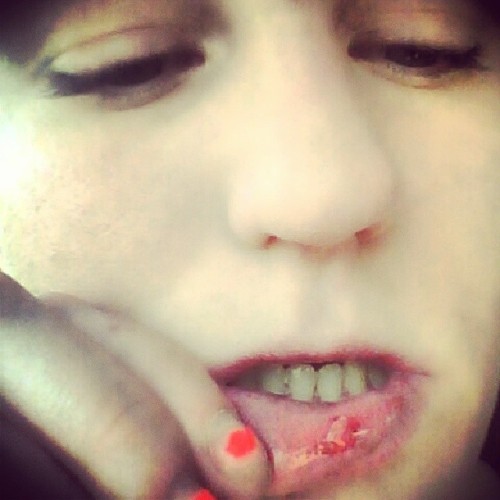 #bitmylip #lipbiting #bruises #cuts #bites #lookinrough #hangover kinda haha