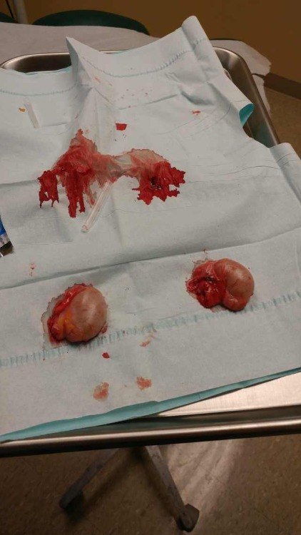 Human testicles after orchiectomy 