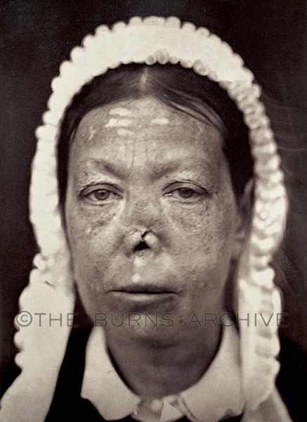 Ozena: Tuberculosis of the Nose, Circa 1870.The dreaded infection ‘Ozena’ was