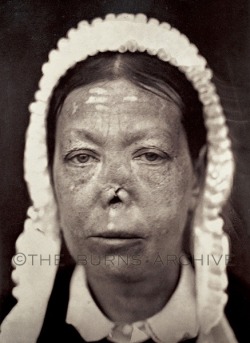 Ozena: Tuberculosis of the Nose, Circa 1870.The