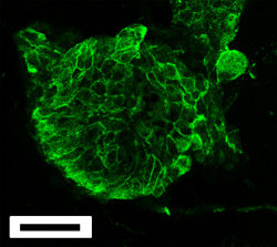 neurosciencestuff:  Researchers develop new approach for studying deadly brain cancer Human glioblastoma multiforme, one of the most common, aggressive and deadly forms of brain cancer, is notoriously difficult to study. Scientists have traditionally