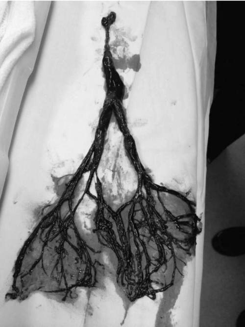 doctor-hannibalism:    80 yr old male with nose bleed for 2 days. Refused to go to ER. Wife finally talked husband to go to ER. He coded shortly after arriving. Medical doctor went to do intubation and found this. They pulled it out in one piece, it’s