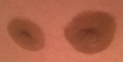 ftmproductreviews:GenderMender ftm prosthetic nipples!Hey guys today I’m going to tell you about a c