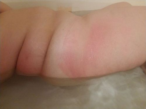 chevygal85: Sunburnt n it sucks but not n a good way like me hehe -k-