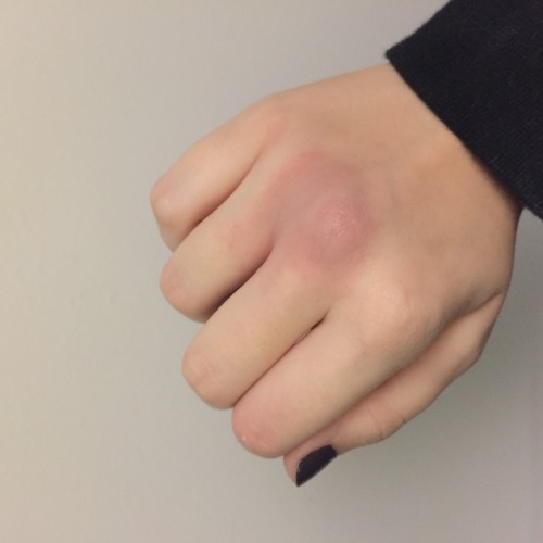 skeletonsilhouette: the evolution of a bruise