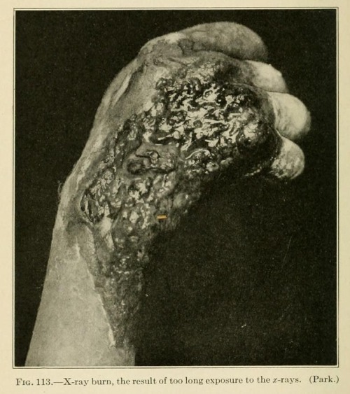 1917. “Radiation burn to the hand Note the necrotic dermatitis present in this burn. This signifies either an extremely high one-time dose, or continued exposure to a moderate dose of gamma radiation. Even with a one-time exposure to the radiation,