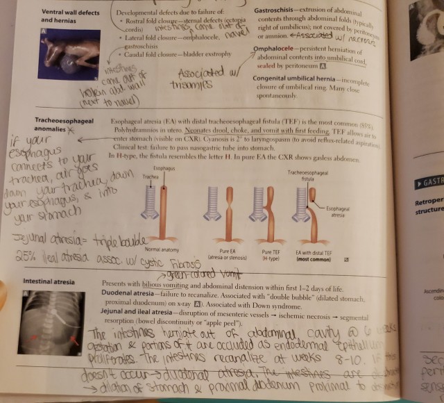 apple peel atresia usmle