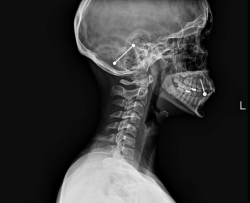 lickyocunt:  Industrial and tongue piercing through X Ray. from /KITTYCOBRA on reddit