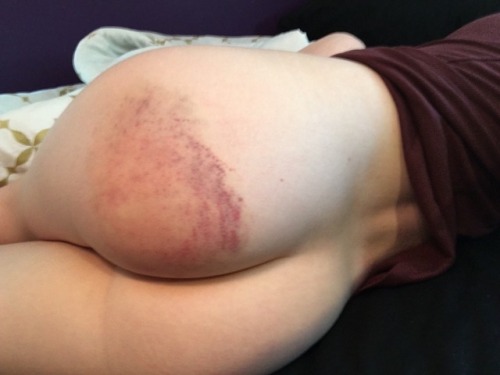 daddys-vodka-princess: I’ve got pretty bruises and a cute ass.