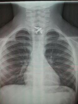 the-absolute-funniest-posts:  leftbehindtime: a girl swallowed a charm from her necklace and had to go to the emergency room One of the best x-rays ever. Jealous. 