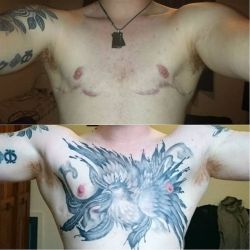 accio-aj:  For people who wonder about how well your chest surgery scars can be tattood over.  These were my scars just before we began my chest piece. You should try and wait a minimum of 2 years before tattooing over scarring to allow the scars to heal