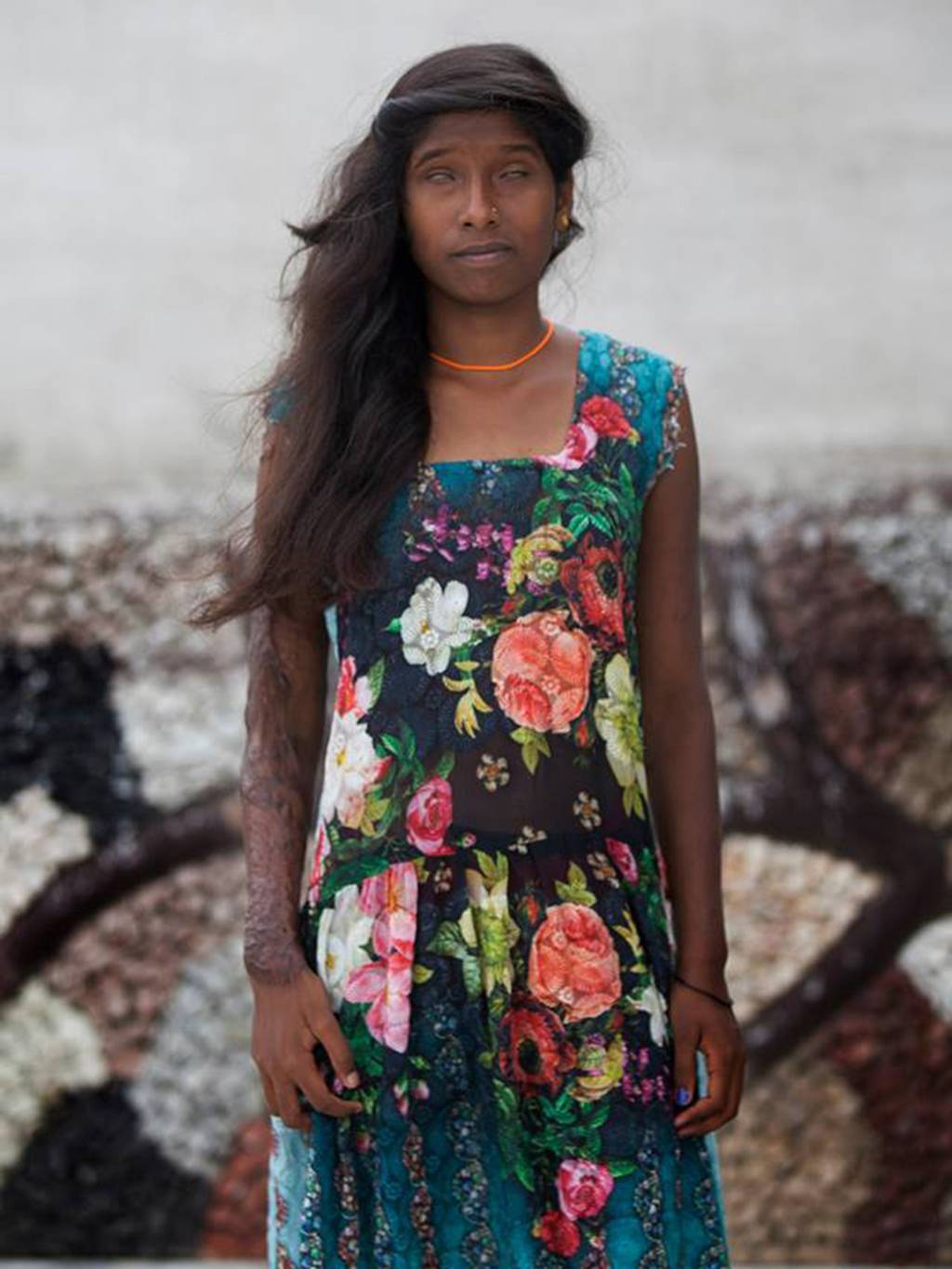 redsuelo:  amberrosehairline:  myvoicemyright:   Acid attack survivors in India model