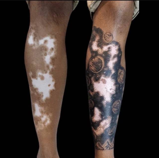 Vitiligo hastalığını...