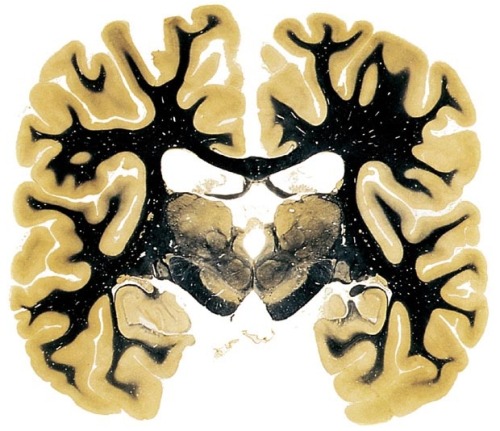 medicalschool:The Human Brain (cross section) at the level of the posterior third of the thalamusMa 