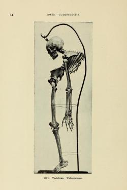 the-two-germanys:  Vertebrae. Tuberculosis.Bulletin of the Warren Anatomical MuseumCambridge: Harvard University Press, 1910. 