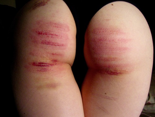 Porn photo holly-gonightly:  The Caning Diaries: Day