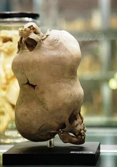 The skull of a young boy with a second imperfect skull attached to its anterior fontanelle.