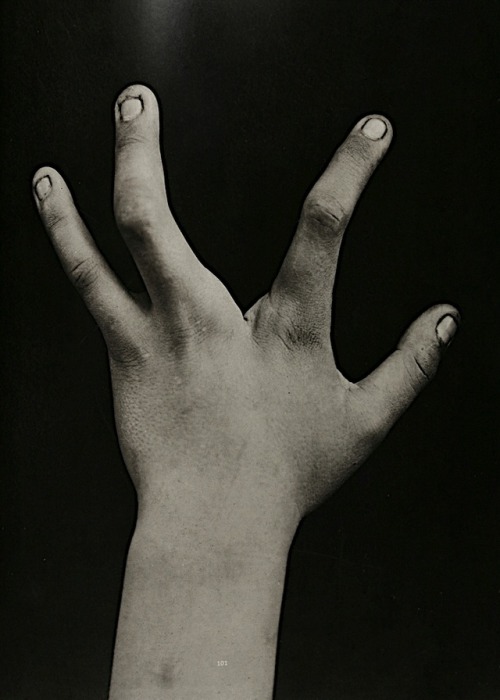 Unknown Photographer - Utrecht Hospital, Holland, 1890. Oligodactyly of the hand is one of the rares