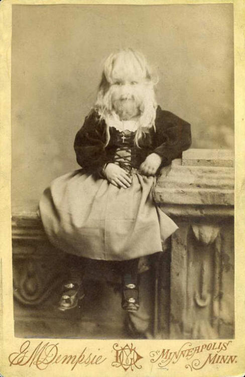 weirdvintage:  Alice E. Doherty was born in 1887 with a rare genetic mutation called “hypertrichosis", or “werewolf syndrome", which causes excessive body hair.  She was billed as “The Minnesota Woolly Baby".  At birth, she was