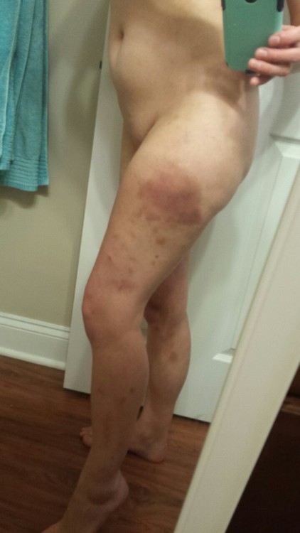 Day 0 of the giant thigh bruise I earned on Saturday and into Sunday. During the scene we had on Sat