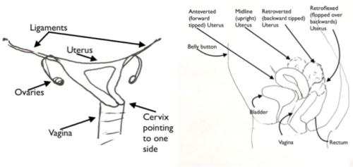 Making Periods Better Series: #2HEAVY CRAMPING & BLEEDING because of uterine position:First of a