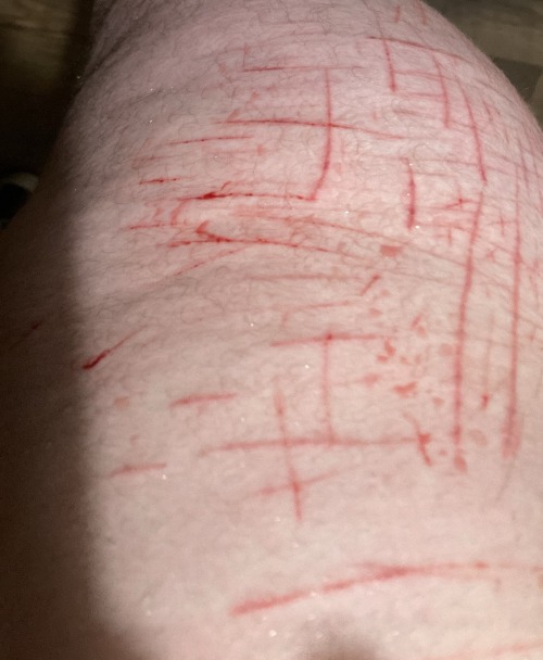 TW Self Harm!