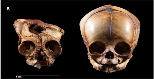 theolduvaigorge: Alterations of skull bones found in anencephalic skeletons from an identified 