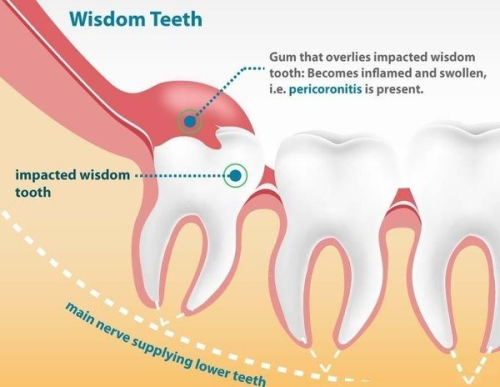 dentagama:  Pericoronitis is a dental condition in which the soft tissues around the erupting crown 