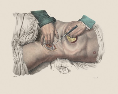 forensicimagination:“The greatest challenge in telling the story of surgery lies in its very nature,