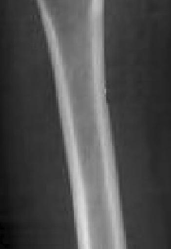 mynotes4usmle:  Paget Disease or Osteitis Deformans Disorder in bone remodeling, 3 stages Osteolytic