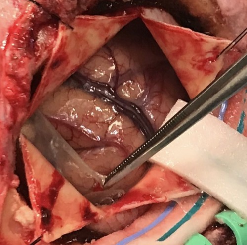 infomedicos:Craneotomía. Apertura de la membrana subdural.